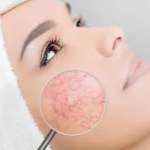 Kuperózna pleť: Príznaky, liečba, kozmetické výrobky